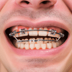 Czy Aparat Ortodontyczny Damon Clear to dobre rozwiązanie dla mnie?